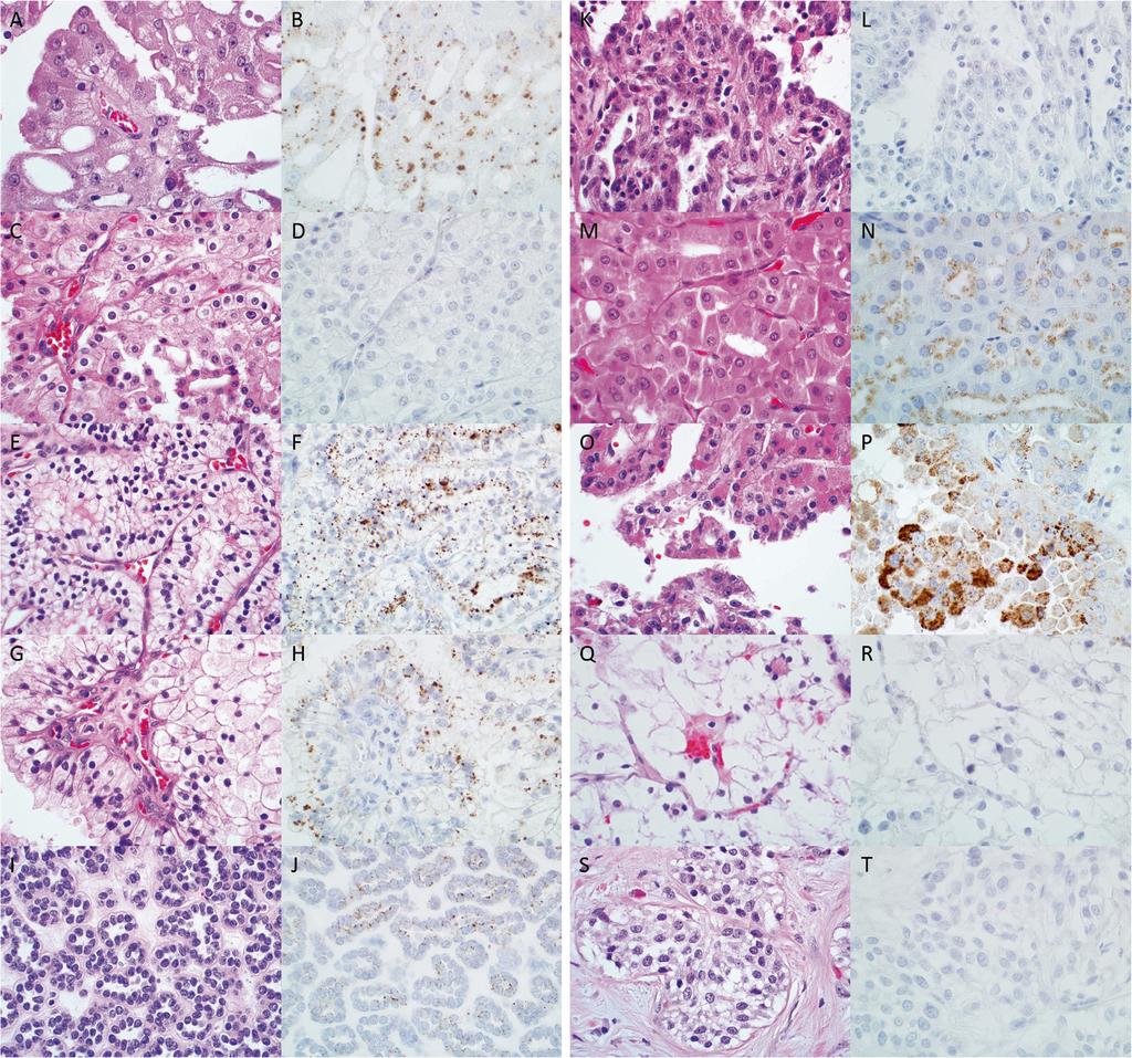 Zhu et al. Diagnostic Pathology (2015) 10:4 Page 3 of 5 Figure 1 Expression of napsin A in various renal neoplasms.