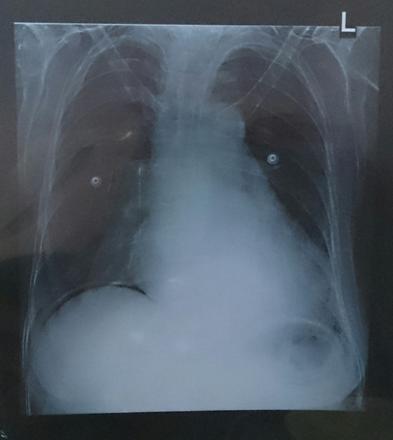 Impression Peritonitis presumably due to Hollow Viscus Perforation: Investigations: Chest X-Ray: Gas under the diaphragm and straightening of the left border of the heart were evident.