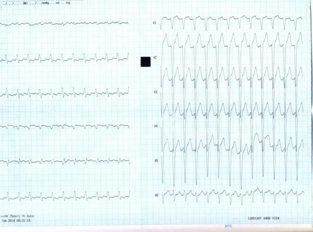 V 6 suggestive of inferolateral ischemic changes. Figure 2: ECG Echocardiography Right atrium and Right ventricle Dilated. Left atrium dilated. Left ventricle normal.