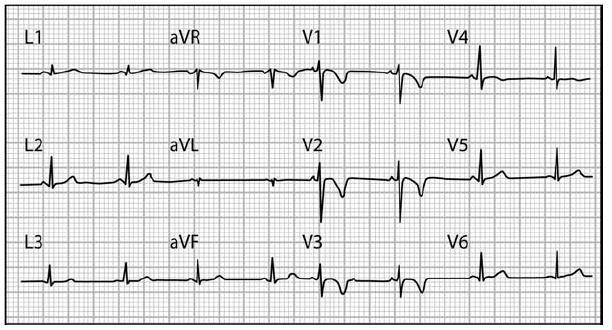 ARVC Right precordial T-wave inversion in a patient with ARVC Note that unlike early