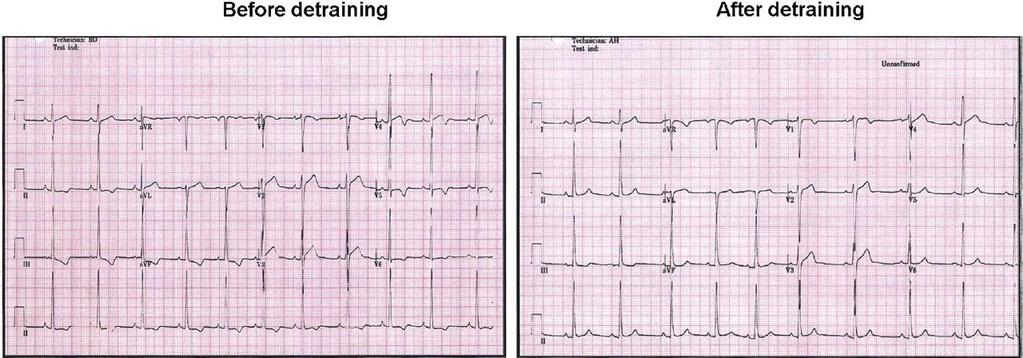 Electrocardiograms of a Swimmer With LVH and Inferolateral T-Wave Inversions Before and After Detraining for 12 Weeks