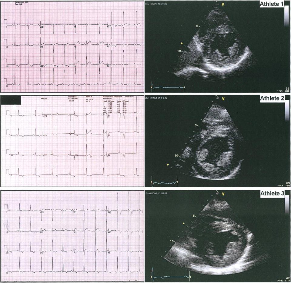 Electrocardiograms and Parasternal Short-Axis Views of the LV at the Level of Papillary Muscle of the 3 Athletes With LVH and a Nondilated LV