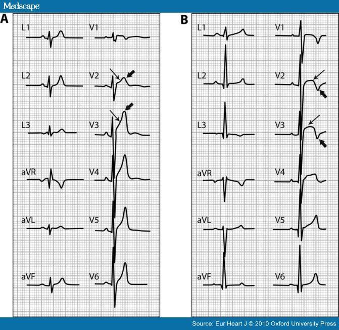 Figure 2. Different patterns of precordial early repolarization in two healthy athletes.