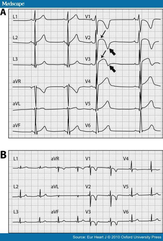 Figure 3. (A) Early repolarization pattern in a healthy black athlete characterized by right precordial T-wave inversion (arrowhead) preceded by ST-segment elevation (arrow).