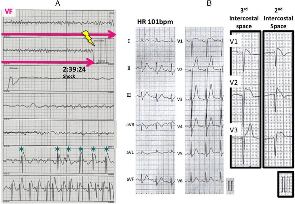 408 KEY TEACHING POINTS Brugada syndrome (BrS) with inferolateral J waves carried a worse prognosis than BrS without.
