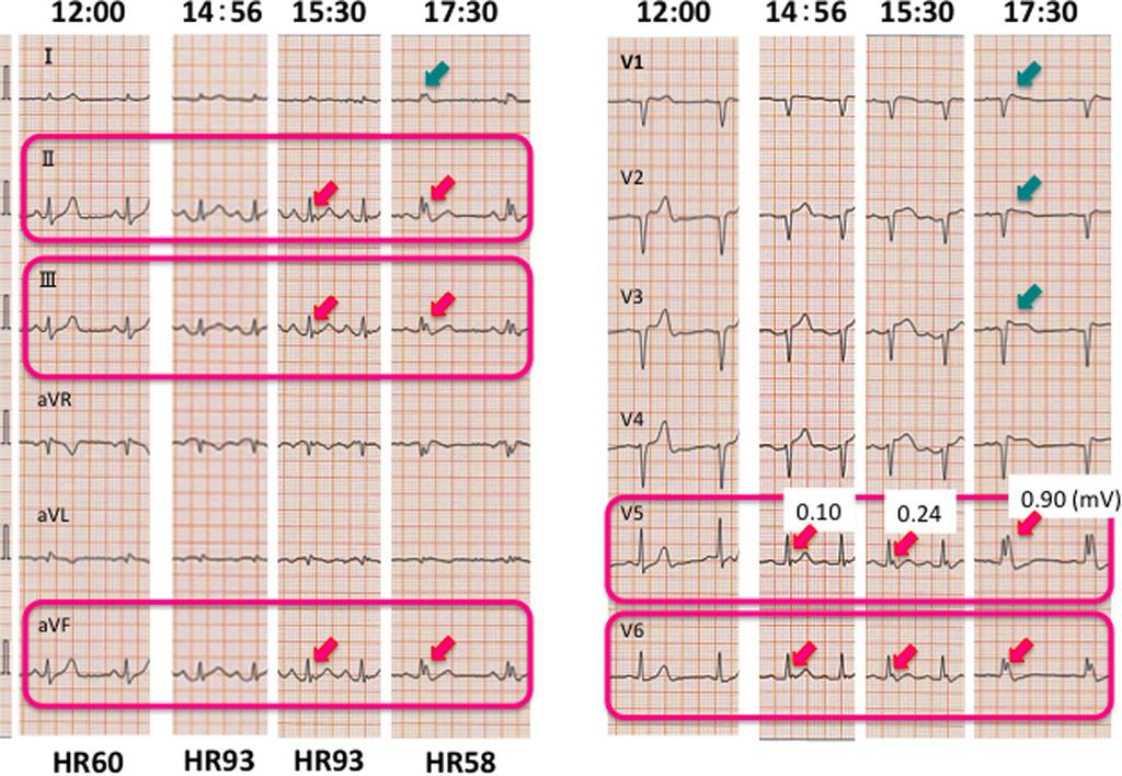 Hada et al Inferolateral J Wave in Brugada Syndrome 409 Figure 2 After a target temperature of 341C was achieved, 12-lead electrocardiogram showed the elevation of J-point first in the lateral leads