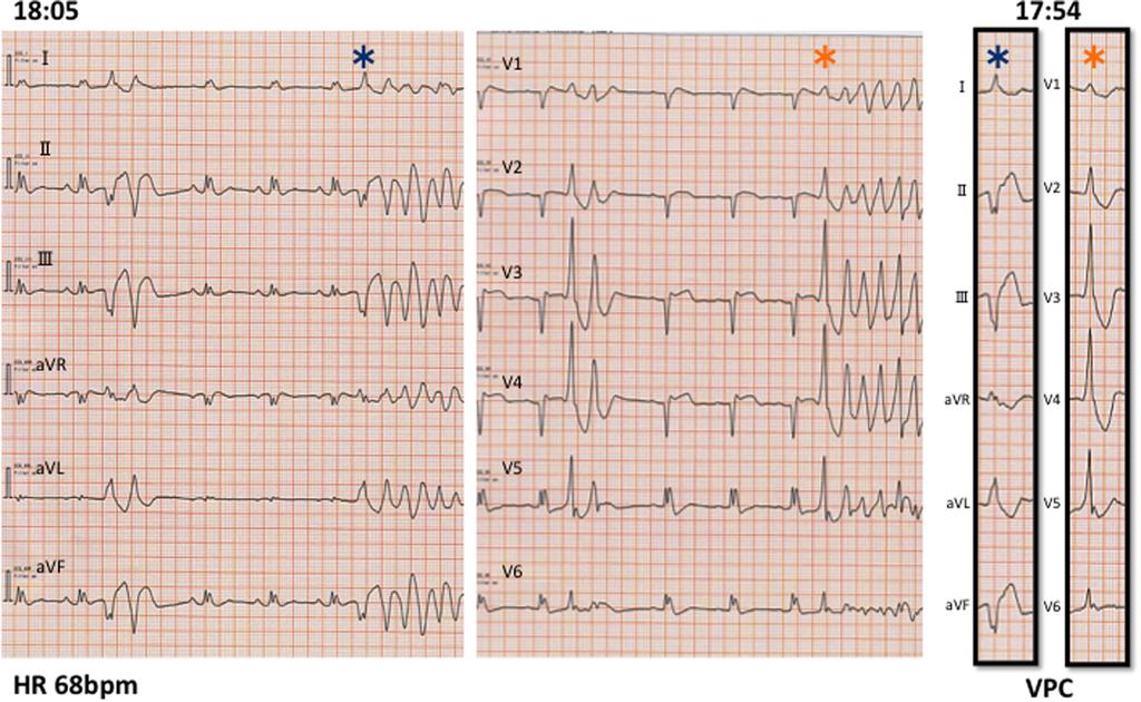 410 Heart Rhythm Case Reports, Vol 2, No 5, September 2016 Figure 3 Ventricular fibrillation started after short-coupled ventricular premature contractions (VPC) exhibiting right bundle branch block