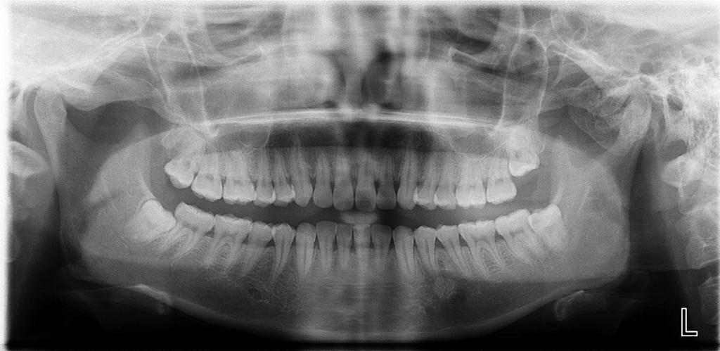 Case report Case analysis A 31-year-old Chinese woman presented at the Department of Oral and Maxillofacial Surgery, Xiangya Hospital, Central South University, complaining of a progressive, painful