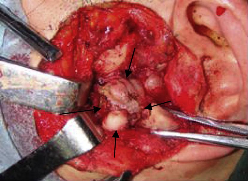 Resection of osteochondroma of the mandibular condyle 93 Figure 4 The tumor was separated from the condyle and removed entirely, without damaging the peripheral anatomic structures.