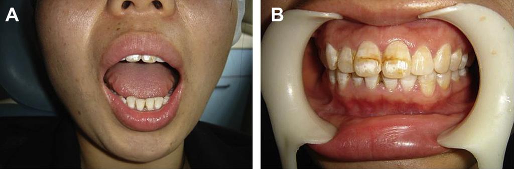 94 O. Liu et al Figure 7 (A) Mouth opening postoperatively was approximately 35 mm. (B) Midline deviation was almost corrected.
