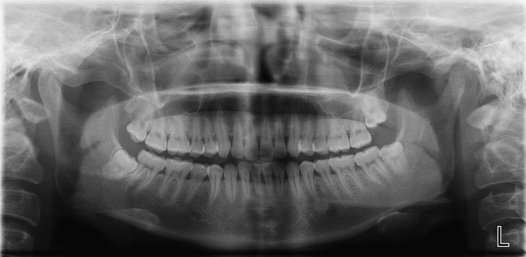 The reason may be that the osseous tumor tissue within the condylar head impinged upon movement of the mandible.