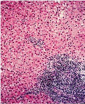 Pathological Changes in Liver Affliction of Liver with HCV Localized Necrosis Normal liver biopsy HCV