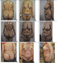 Circular Abdominoplasty (Belt Lipectomy) in Obese Patients http://dx.doi.org/10.