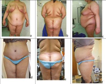 118 Body Contouring and Sculpting Figure 10. 36 years old patient undergone circular abdominoplasty.