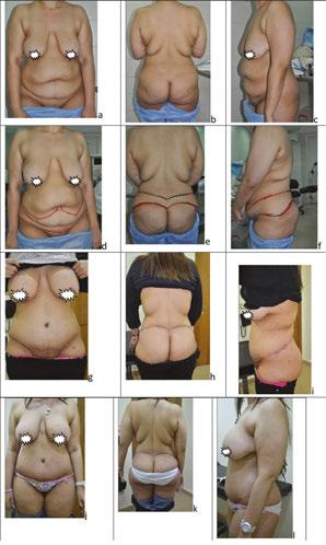 Circular Abdominoplasty (Belt Lipectomy) in Obese Patients http://dx.doi.org/10.5772/65334 119 Figure 12. 38 years old patient undergone circular abdominoplasty operation.