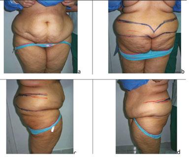 Circular Abdominoplasty (Belt Lipectomy) in Obese Patients http://dx.doi.org/10.5772/65334 111 fascia that covers the aponeurosis of the external abdominal oblique muscle.
