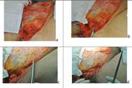 Circular Abdominoplasty (Belt Lipectomy) in Obese Patients http://dx.doi.org/10.5772/65334 115 Wasief Sh.