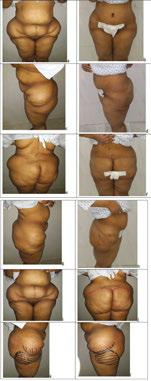 116 Body Contouring and Sculpting Eleven patients (29.7%) were not satisfied with the long 360 scar in the first 6 months, reduced to seven patients (18.9%) after scar maturation, two patients (5.