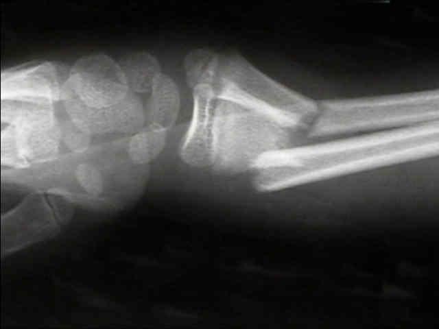 Prospective, randomized trial of patients 4-12 years old who had a distal radial or distal both-bone forearm fracture.