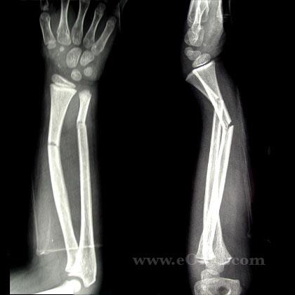 Long arm casting In a small randomized controlled trial of displaced diaphyseal forearm fractures, long arm casting for 6 weeks was compared to long arm