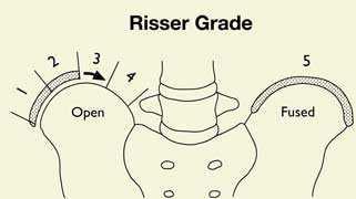 Endpoints Success Cobb angle less than 50 degrees and skeletal maturity Failure Risser 4 (5 for