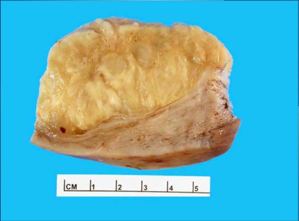 Gelatinous, mucoid or myxoid