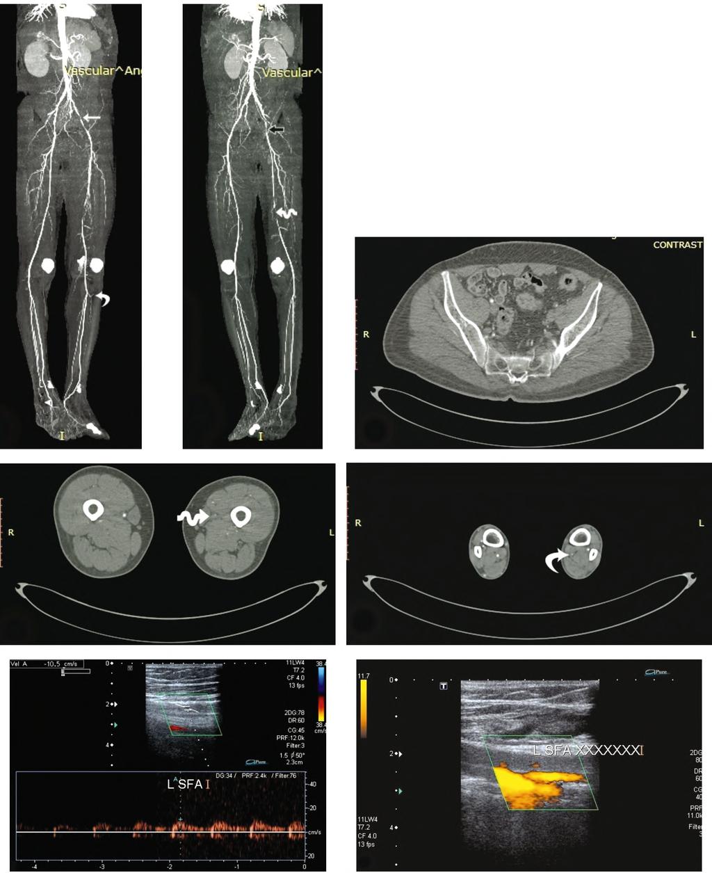 Nadine R. Barsoum, et al. 179 (A) (B) (C) (D) (E) (F) Fig. (1): (A-G): Male diabetic and hypertensive patient, 61 years old, complaining from severe pain in the left leg.