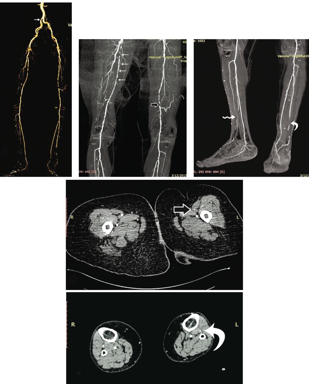 180 Peripheral Arterial Disease of the Lower Limbs (A) (B) (C) (D) (E) Fig. (2): (A-E): Female diabetic patient 75 years old complaining from severe bilateral lower limb pain. CTA of the lower limbs.