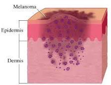 Melanoma Malignant tumor of the pigment-producing melanocytes Surgical resection
