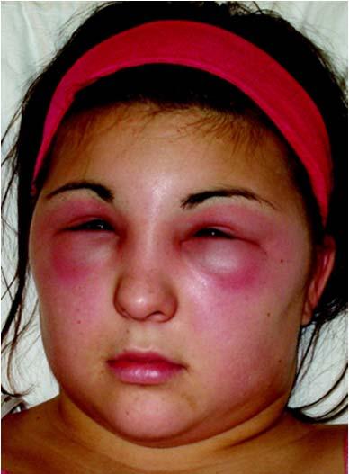 Skin sensitization A skin sensitiser can cause an allergic response following skin contact