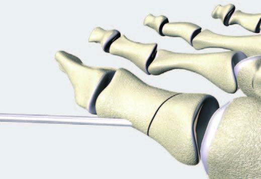 Surgical technique 2-hole plate Fixation of an Akin osteotomy Preoperative planning is not described. 1 Osteotomy A medial incision is made. Perform the osteotomy. Retain the lateral cortex.