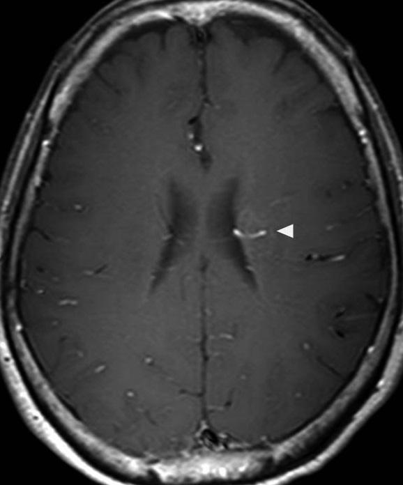 Initial ordinary CT images of the brain displayed a subtle hypodense area in the left basal ganglia, but no mass effect or acute hemorrhagic focus was identified (Fig. 1A).