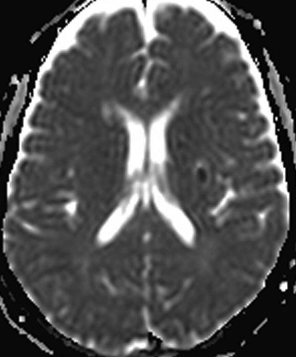 The perfusion study showed relatively increased cerebral blood volumes (rcbv) and cerebral blood flows (rcbf) with an associated prolonged mean transit time (MTT) and time to peak (TTP), as