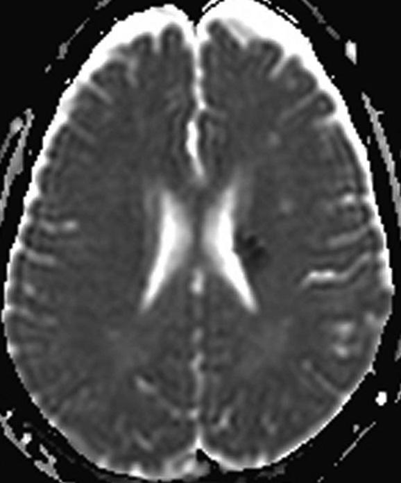 Venous infarction of developmental venous anomaly in a 63-year-old woman who presented with an acute onset of right side motor weakness and sensory changes.