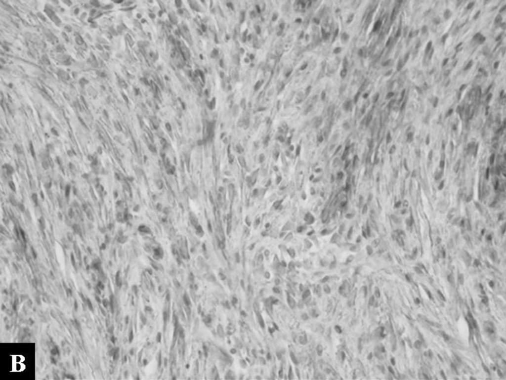 cell admixed with less cellular hyalinized areas () (H & E, 200).