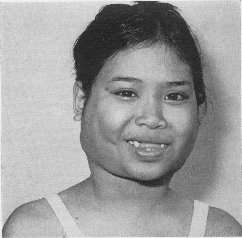 Postgraduate Medical Journal (July 1980) 56, 521-525 Diffuse cutaneous involvement and sinus histiocytosis with massive lymphadenopathy A. A. WOODCOCK B.Sc., M.B., Ch.B., M.R.C.P. Summary Severe skin involvement complicated a case of sinus histiocytosis with massive lymphadenopathy in a young Malay girl.