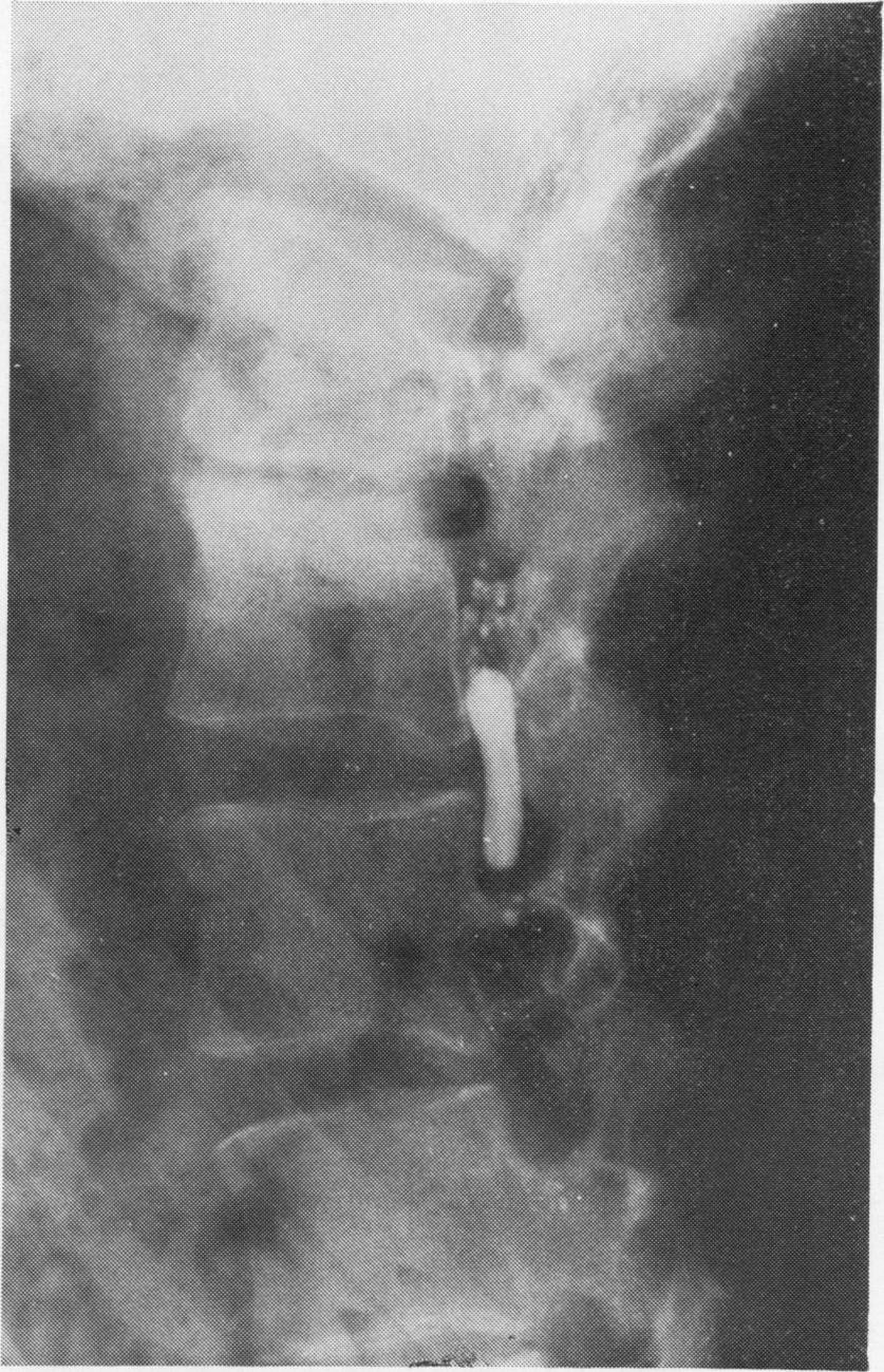 CASE 4 This 34-year-old man developed an acute low back pain while using a meat grinder. After 5 months he was put in an exercise and intermittent lumbar traction, with improvement.