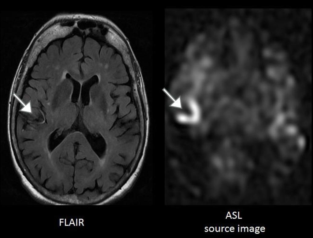 Fig. 11: In this patient with acute stroke, the FLAIR sequence revealed a vascular hyperintensity within the right middle cerebral artery related to reduced blood flow (FLAIR image, arrow).