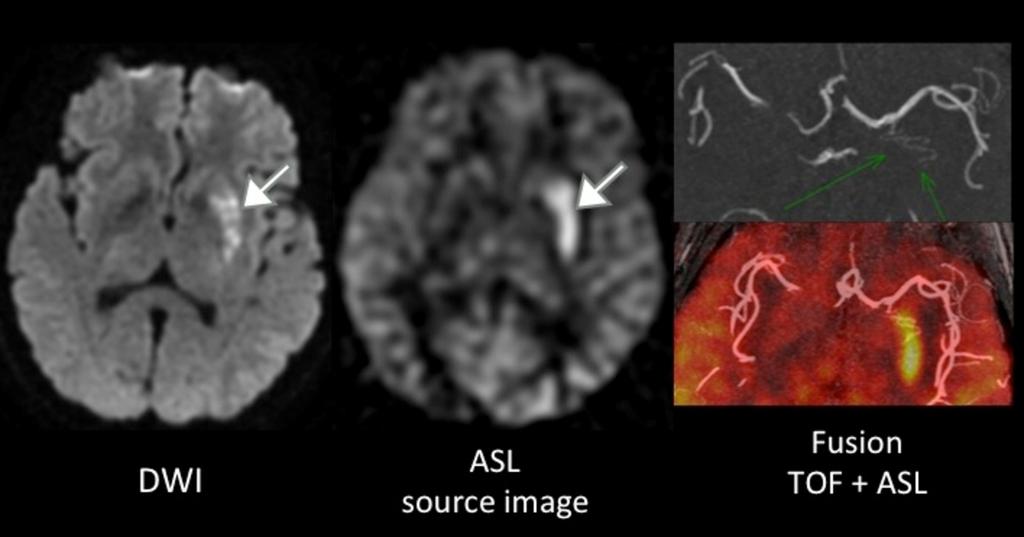 13: Diffusion, ASL and TOF MR sequences in a patient with acute stroke in the left middle cerebral artery territory.