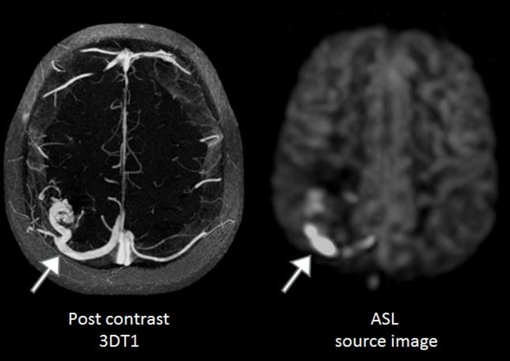 Fig. 14: Post contrast 3D T1 weighted and ASL images in a
