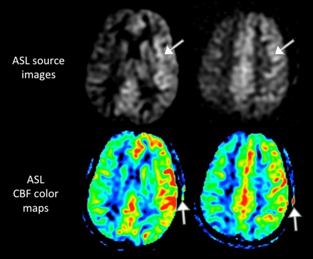 Fig. 17: ASL source images and color CBF maps in a patient with migraine.