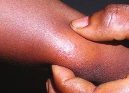 A new case is a person with no previous history of treatment for Buruli ulcer. A recurrent case is a person presenting within one year with a further lesion at the same site or at a different site.