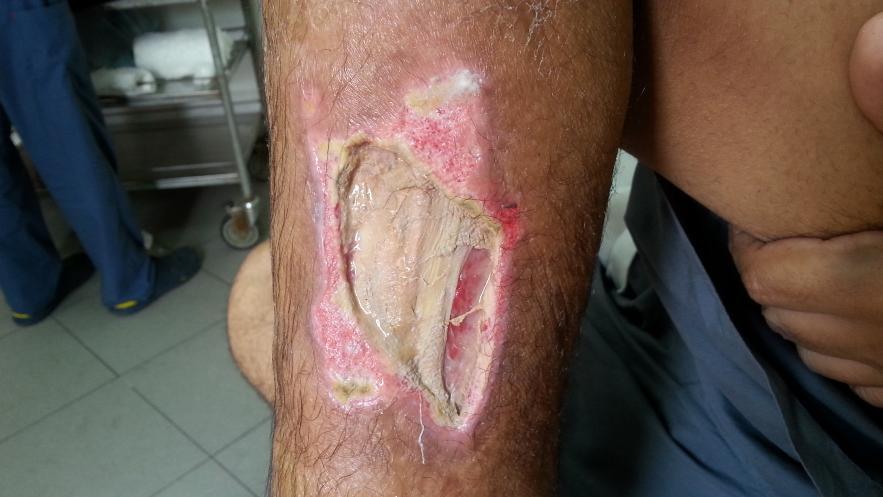 Figure5a-Deep infection in leg ulcer in diabetic patient. note the suppuration in the wound and the sign of infection.
