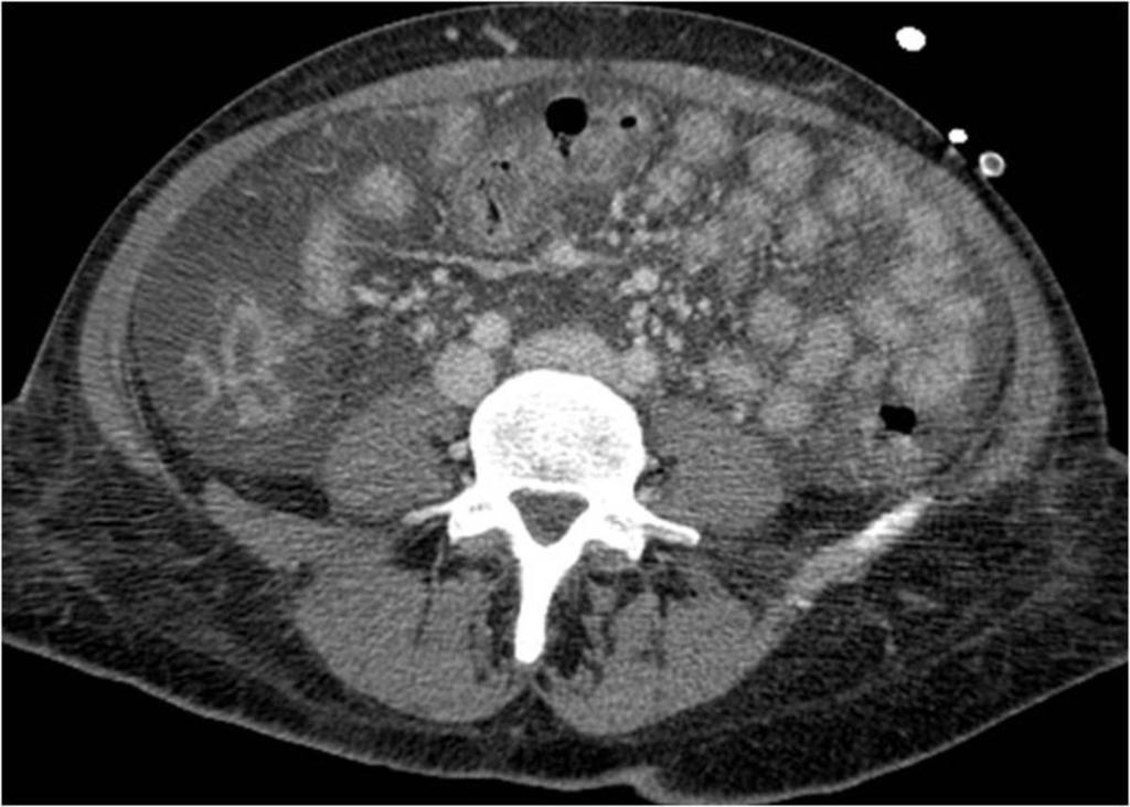 Fig. 5: In 3 patients with toxic hepatitis with oral ingestion of the