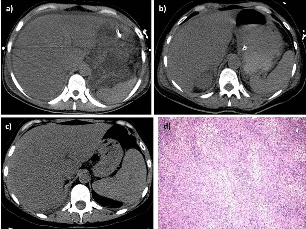 Fig. 1: Precontrast MDCT images show a diffuse low density liver parenchyma in patients with acute hepatitis of different etiology: toxic hepatitis