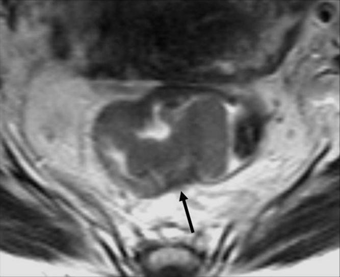 Page 3 of 10 Figure 2 The axial T2TSEwi sequence show a typical T2-stage lesion infiltrating muscolaris propria but limited to the bowel wall, which may be identified as the black line around the