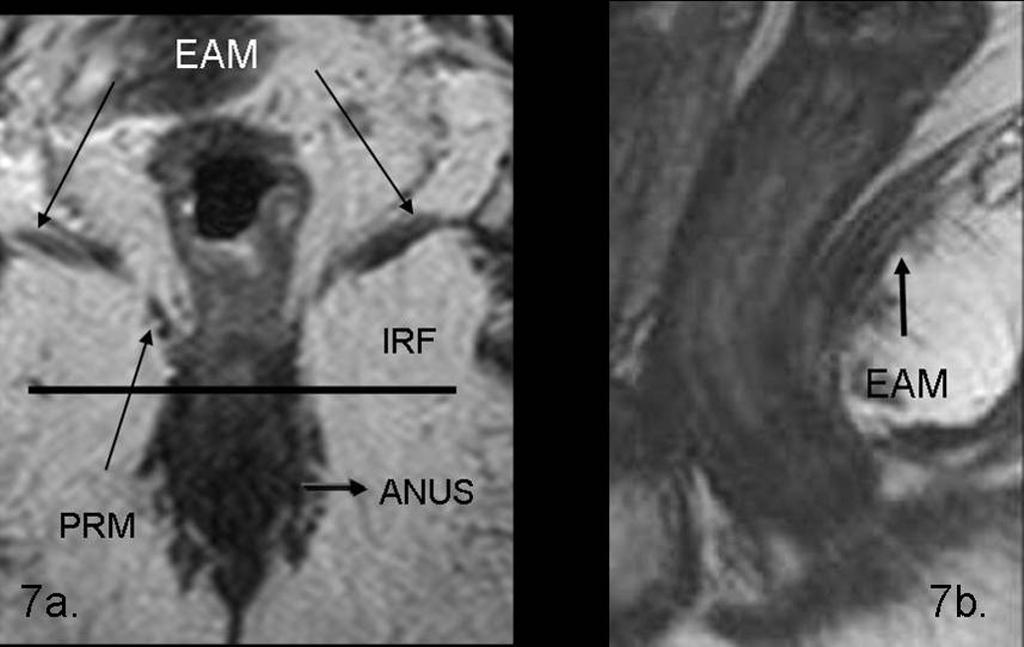Figure 6 Axial T2 TSEwi demonstrates a T2-stage rectal cancer bounded by the mesorectal fat and the mesorectal fascia; in particular the latter structure is appreciated on T2wi as a fine line of low
