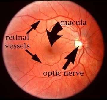 optic nerve, blind