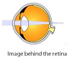 hyperopia: far sightedness lens too weak or