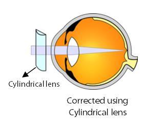 astigmatism cornea has different